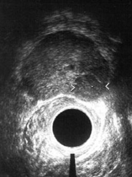 Rektal-Sonografie der Prostata Rektal-Sonografie der Prostata